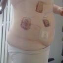 day after, swollen and with rather horrid bloody plasters...