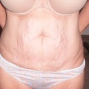 Before new tummy