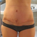 3 weeks po, incision is healing really nicely, not a fan of belly button yet but not that concerned about it.