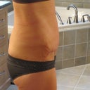 profile 3 weeks po- pic taken in morning, swelling has gone way down