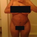 front view of stomach 5 weeks post op