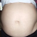 My big belly 3 1/2 weeks prior to surgery