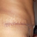 Right side, wow so different from the left side, 1 month