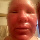 48 hours after fraxel. very swollen. no more oozing. everything going good.
