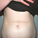 Before surgery, front view.
