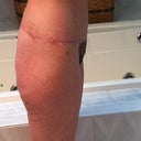 Almost 4 1/2 months after arm/breast surgery and 4 months after LBL
