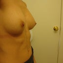 Side view pre-op 200cc implants