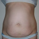 Before surgery