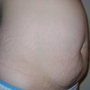Before surgery