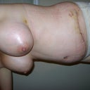 After surgery day 9