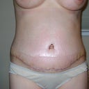 After surgery day 9