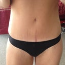 4 months post op