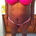 pre-op front view