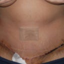 First look at tummy 4 days post op! haven't even showered yet!