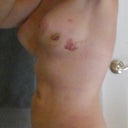 post-op day 11. 8/16/2011