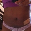 Day 4- very swollen but compression line is gone and skin is tighteninbg
