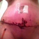 1 week PO. Very swollen and brusied and not nearly as sore as I thought I would be.