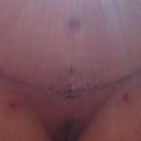 2 week PO. Just had my drains removed as well as Steri-strips. Some swelling has reduced and is easier to move around.