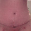 3 week PO. Can start to tell my shape a little better!