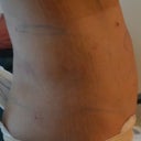 24 hours Post Op