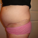 9 weeks - still distended/swollen whatever you want to call it.....really sucked