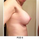 R side - swelling significantly improving