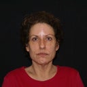 before facelift & necklift