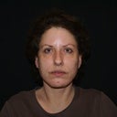 after face & neck lift