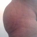 Day after Surgery