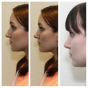 LEFT PROFILE: before (left), morphed image Dr. B created (middle), and 2.5 months post-op (right)