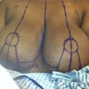 Surgeon's markings before surgery :-)