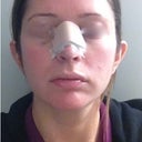 Day 5 after surgery