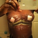 post op day 2 with vac via negative pressure band aid on