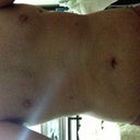 2 weeks post-op, normal front torso view. Taken with front iphone camera (not the best sorry). Not sure why they are positioned like this in the quick-view mode, enlarge them to see the normal view. Sorry guys and gals!