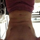 2 weeks post-op, slight bend over (notice how theirs less 'rolls' as compared to before).