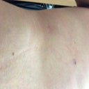 2 weeks post-op, cannula puncture sites. Not bad! Healing quickly, applying scar reducing cream on them daily.