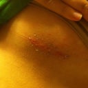Day 12 left scar. It's a little pink, but beautiful. The black/brown is the remaining skin glue that hasn't come off. :)
