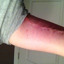 This is exactly 21 days after the surgery.