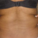 back love handles