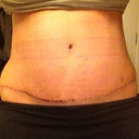 12 Days PO/ No Drains   You can see how swollen my hips still are.  I can't wait to see all that go away.