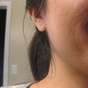 Here's what my skin looked like right before I chickened out of the 4th ipl, and it looks this way now. This skin started forming right after my 3rd ipl.This is what I think people need to take into consideration, you may be risking a few blemishes and switching it out for this in exchange.