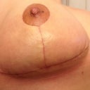 Righty. Loving the Bio Oil!!! Still swollen. This is the side I popped a stitch on. I also think this side is a little larger than the other, but, I am still very happy!!!