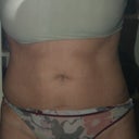Before surgery