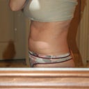 Before surgery