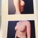 Before Photos-other angle. These are the only photos my surgeon had in his file for me and he took out the originals and gave them to me, during my last and final visit. The spots are on the photo, not on my skin.