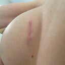 my left breast from below--April 8th 2013 (surgery was on Dec 11th 2012)-incision clearly not in the correct place