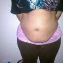 My Horrible looking Belly Prior to Surgery!