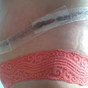 8 days PO --  The left side of the picture is my stomach.