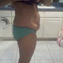 after surgery weighing at 125 lbs.