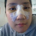 when they had to switch different splint cast since the other one looked really bad.. My nose looks really huge on this one.